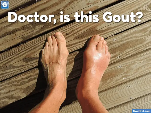 Doctor, Is This Gout?