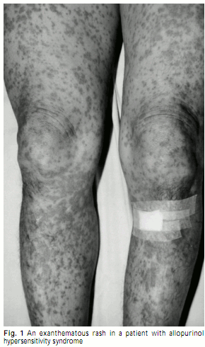 Allopurinol Hypersensitivity Rash